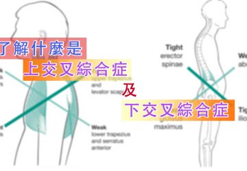 了解什麼是上交叉綜合症及下交叉綜合症